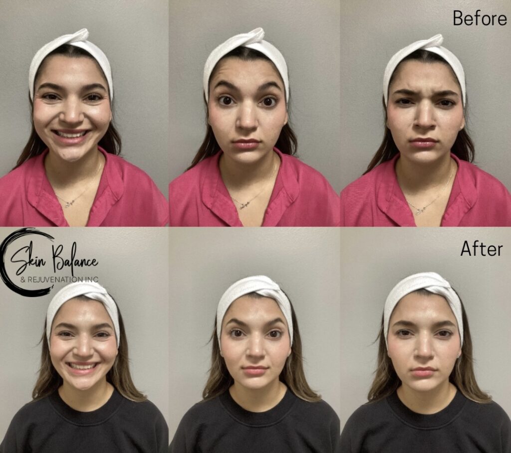 Before and After Image: Botox - front