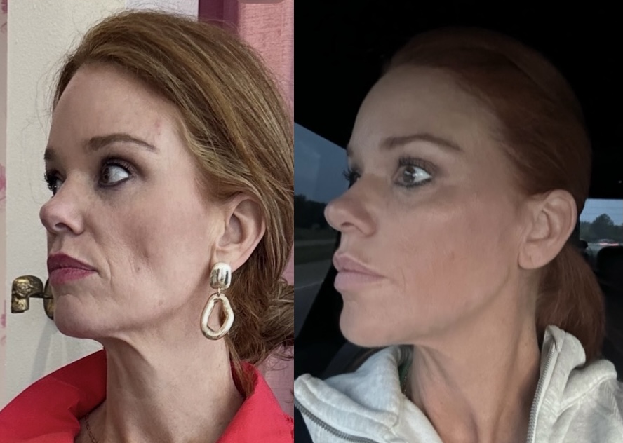 Before and After Image: Liquid Facelift - left-front-oblique