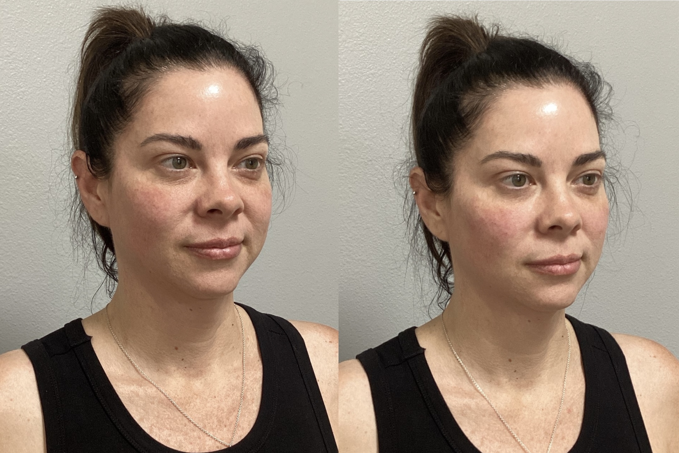 Before and After Image: Undereye Midcheek Filler - right-front-oblique