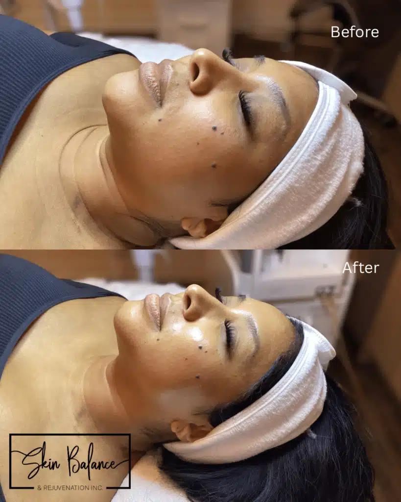 Before and After Image: Diamond Glow Facial - front