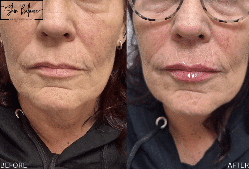 Before and After Image: Lip Filler - front